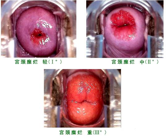 宮頸糜爛最新手術(shù)治療，重拾自信與健康的秘訣?