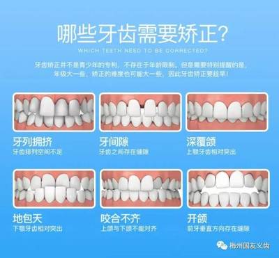 最新牙齒矯正技術(shù),最新牙齒矯正技術(shù)，步驟指南