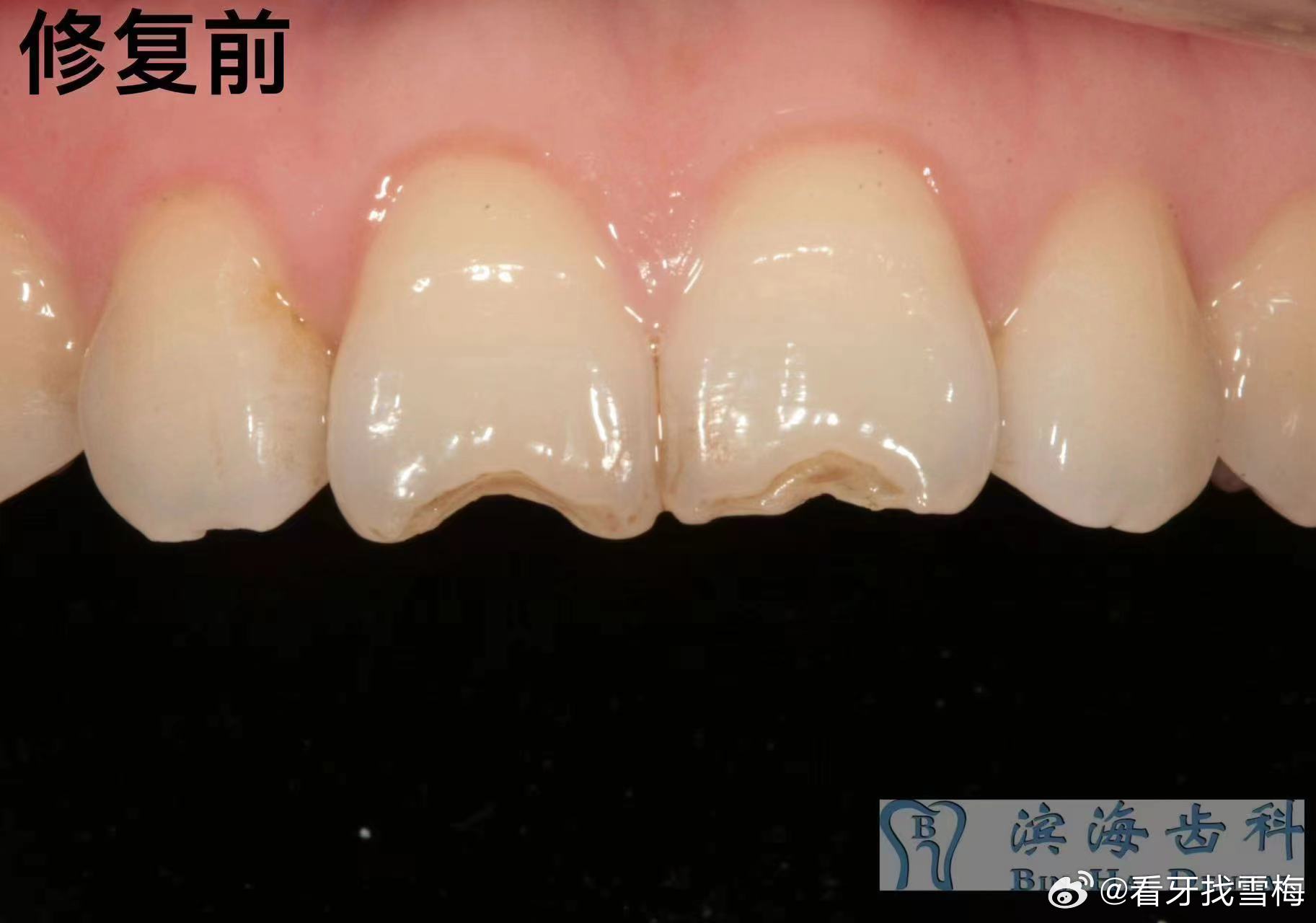 最新牙齒修復(fù)技術(shù)，重塑一口新牙的神奇之旅