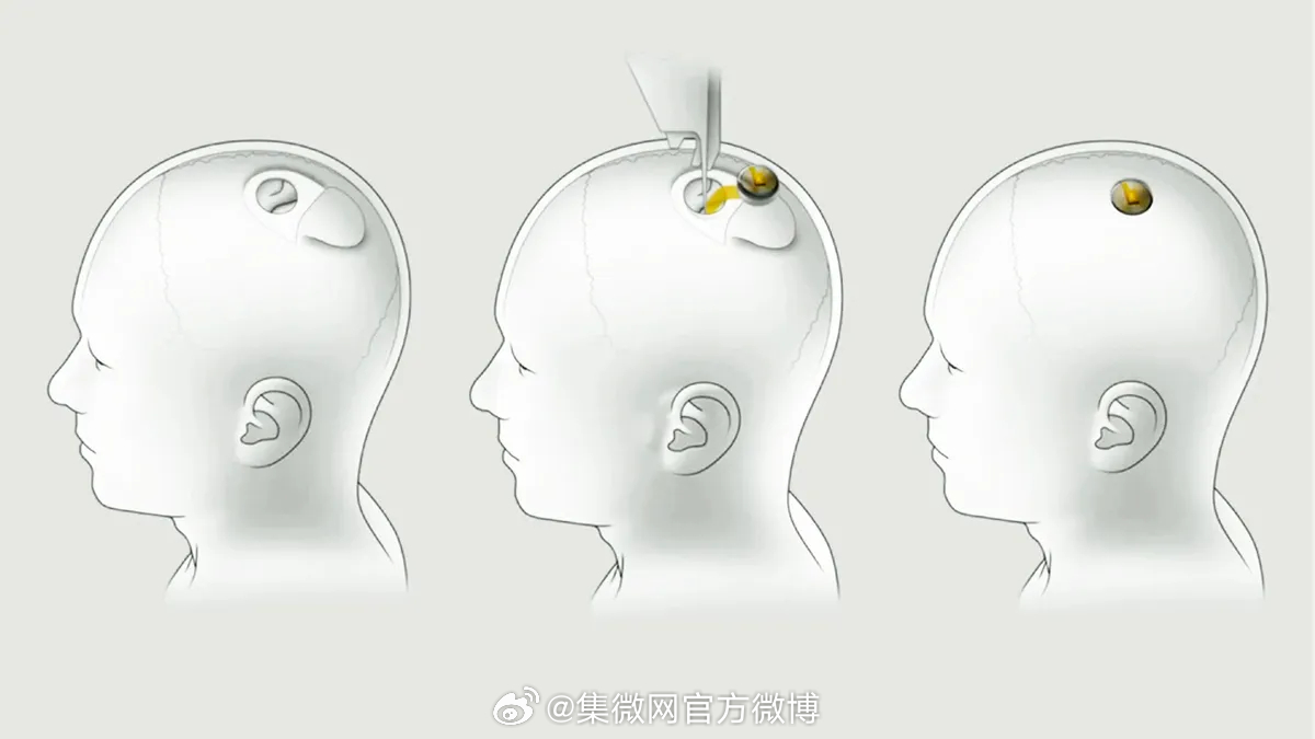 腦控芯片最新取出技術(shù)，心靈與自然的奇妙之旅